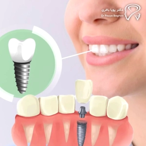 چرا فاصله بین کشیدن دندان و کاشت ایمپلنت مهم است؟