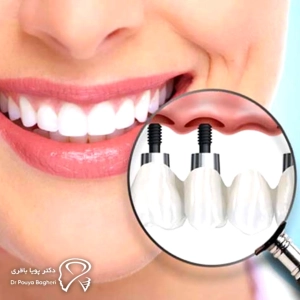 ایمپلنت همزمان با کشیدن دندان: چه زمانی مناسب است؟