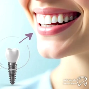 شرایط لازم برای ایمپلنت همزمان با کشیدن دندان