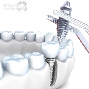 سلامت استخوان فک: پایه موفقیت ایمپلنت