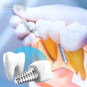 سلامت استخوان، وضعیت لثه، کنترل عفونت و شرایط عمومی بیمار مهم‌ترین عوامل تعیین‌کننده مدت زمان موردنیاز برای ایمپلنت بعد از کشیدن دندان هستند.