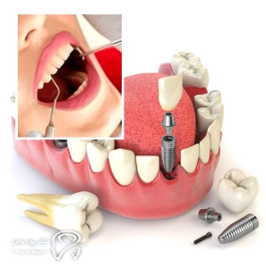 سوالات رایج بیماران درباره ایمپلنت بعد از کشیدن دندان