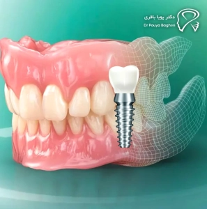 ایمپلنت دندانی در برابر دندان مصنوعی