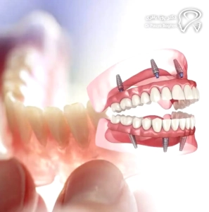 چرا مقایسه ایمپلنت و دندان مصنوعی اهمیت دارد؟ 🎯