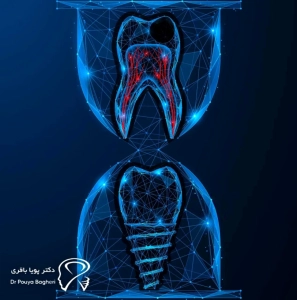 نرخ موفقیت ایمپلنت در مقایسه با دندان مصنوعی