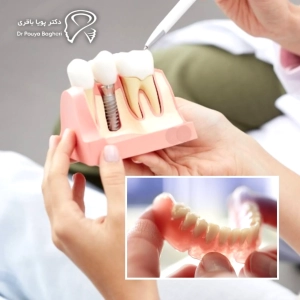 فواید بلندمدت ایمپلنت برای استخوان فک