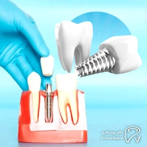 مقایسهی ایمپلنت و دندان مصنوعی