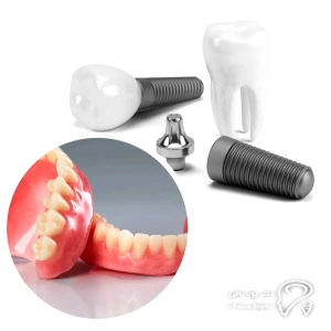 نکات مهم پیش از تصمیمگیری بین ایمپلنت و دندان مصنوعی