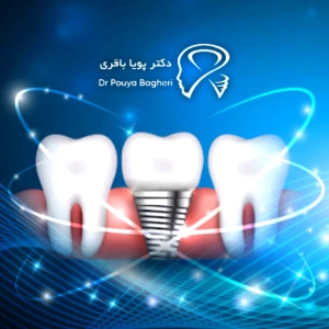 چرا مطب ما انتخابی مطمئن برای ایمپلنت شماست؟