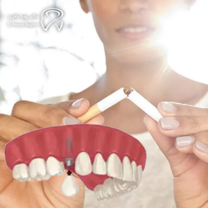 تا چند روز بعد از جراحی ایمپلنت نباید سیگار کشید؟