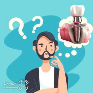 ایمپلنت تا چه حد می‌تواند ماندگار باشد؟