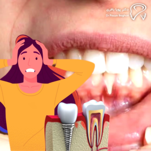 تحلیل لثه — مشکل زیبایی‌شناختی، نه خرابی ایمپلنت