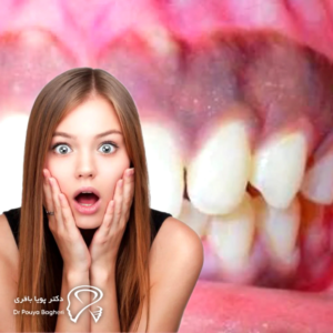 تغییر رنگ لثه یا سایه فلزی زیر لثه