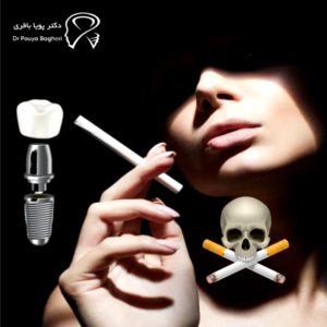 پرهیز از سیگار؛ مهم‌ترین عامل جلوگیری از خراب شدن ایمپلنت